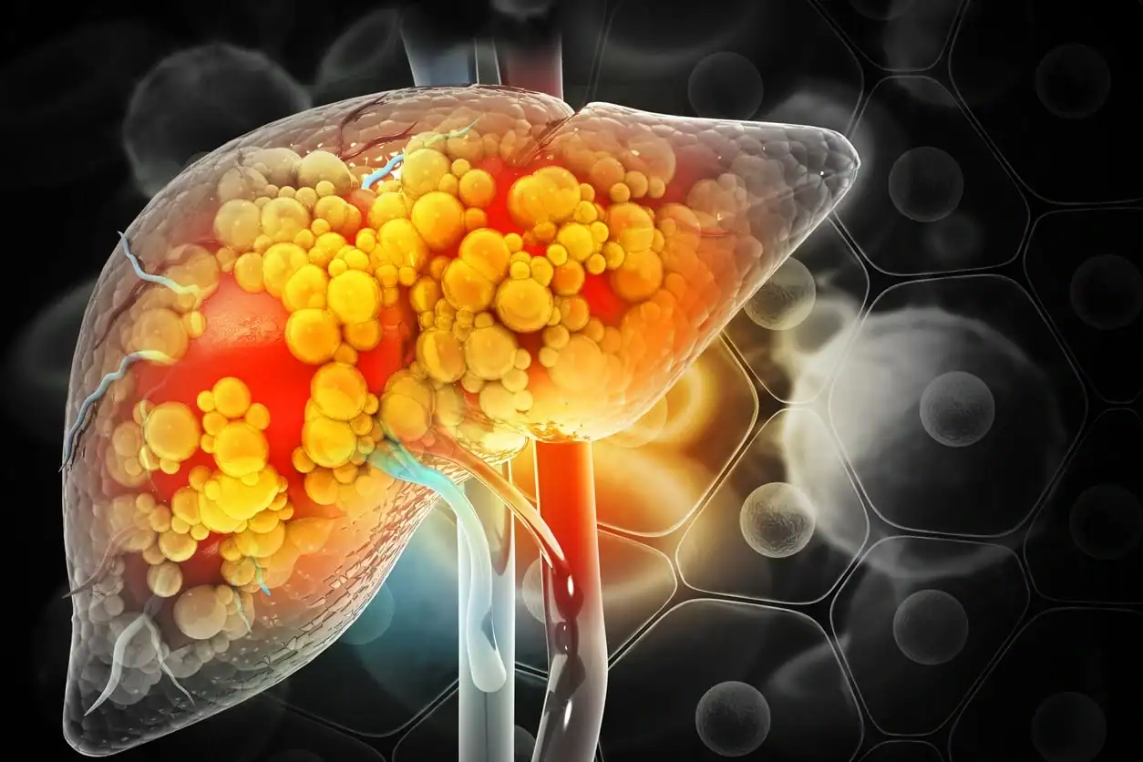 Diet Drinks harm Liver more than Sugary drinks